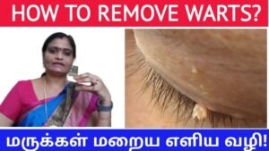 How to remove warts? |Homeopathy treatment 2020 | மருக்கள் மறைய எளிய வழி! |Master Mano|Tamil | V